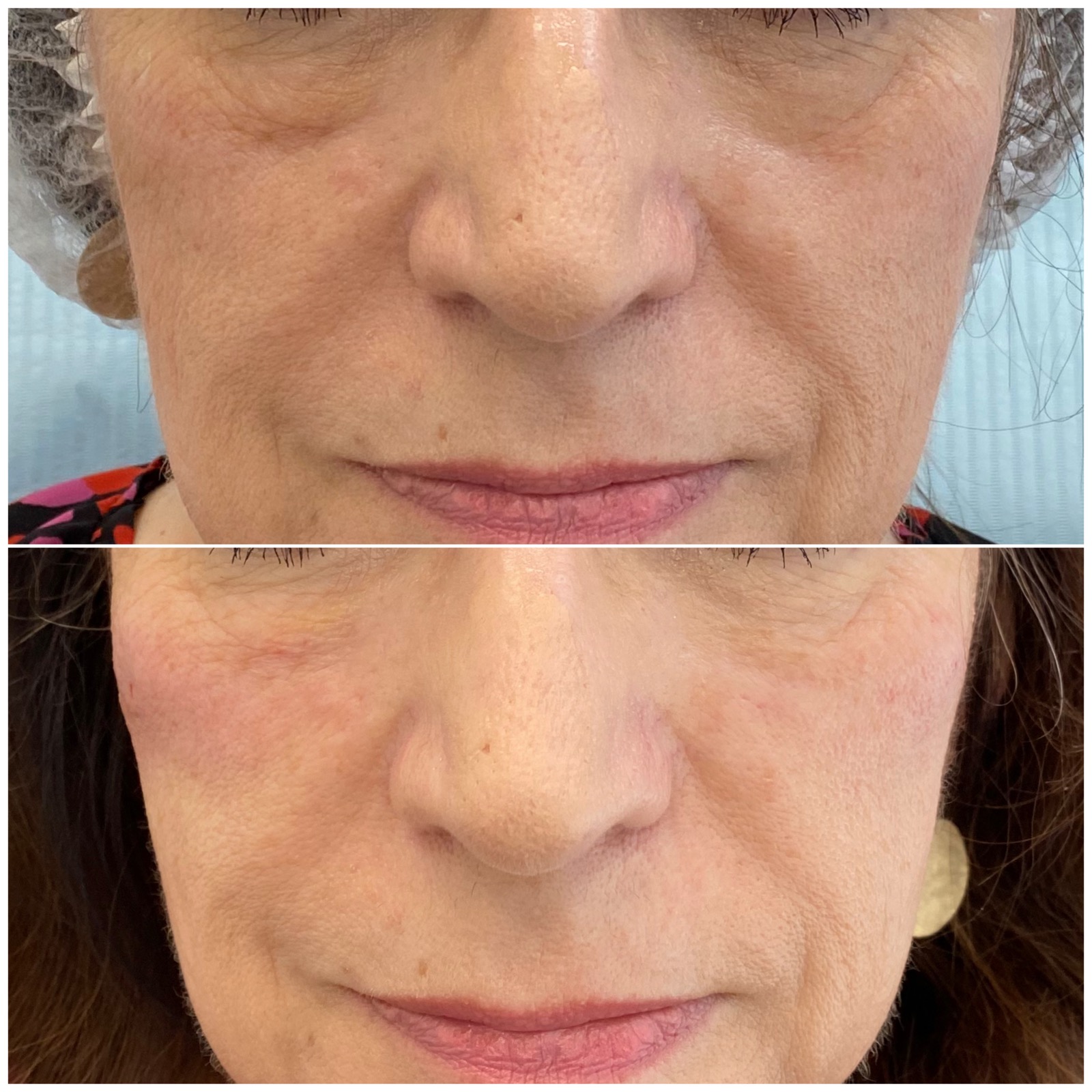 Medycyna estetyczna - przykład zabiegu 10