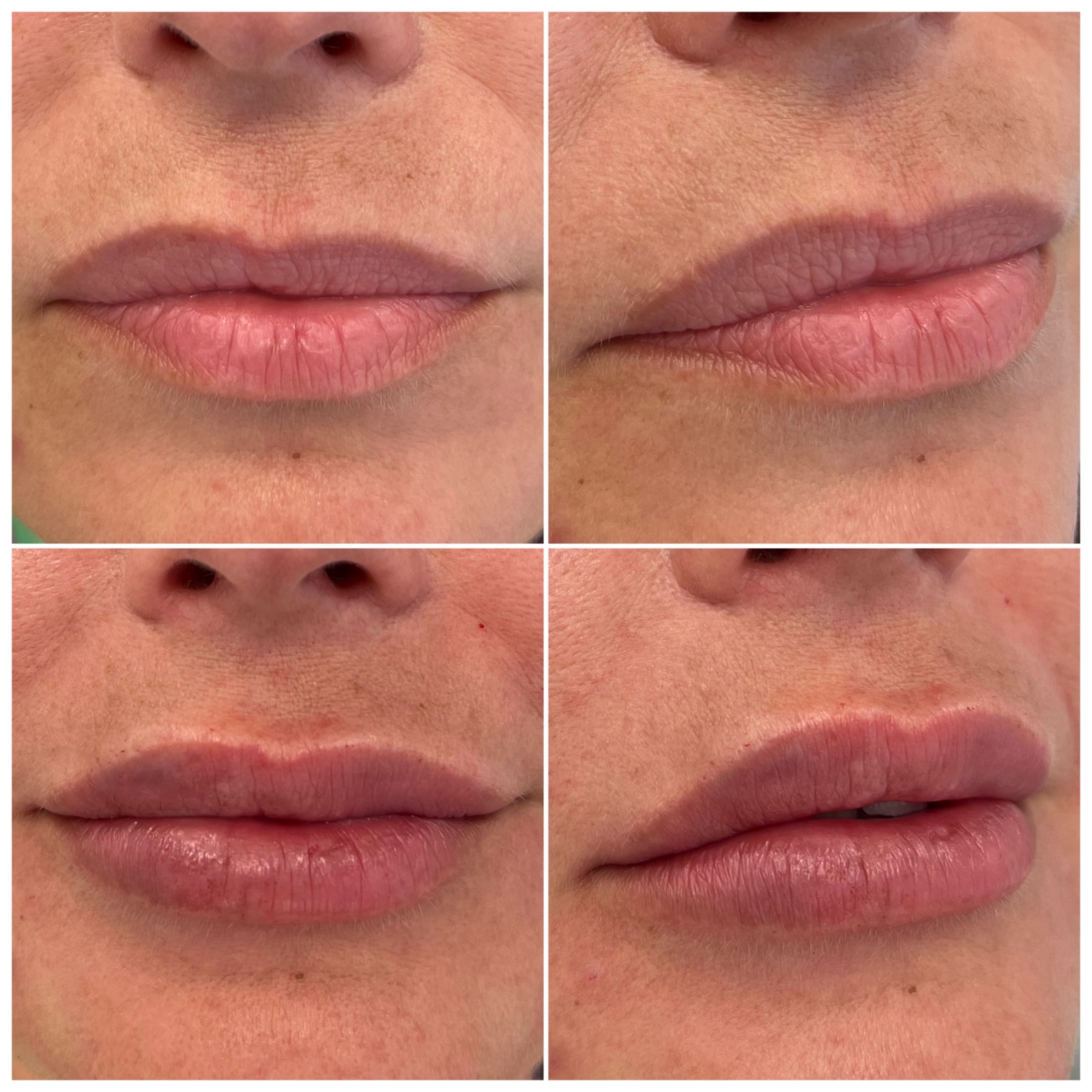 Medycyna estetyczna - przykład zabiegu 11