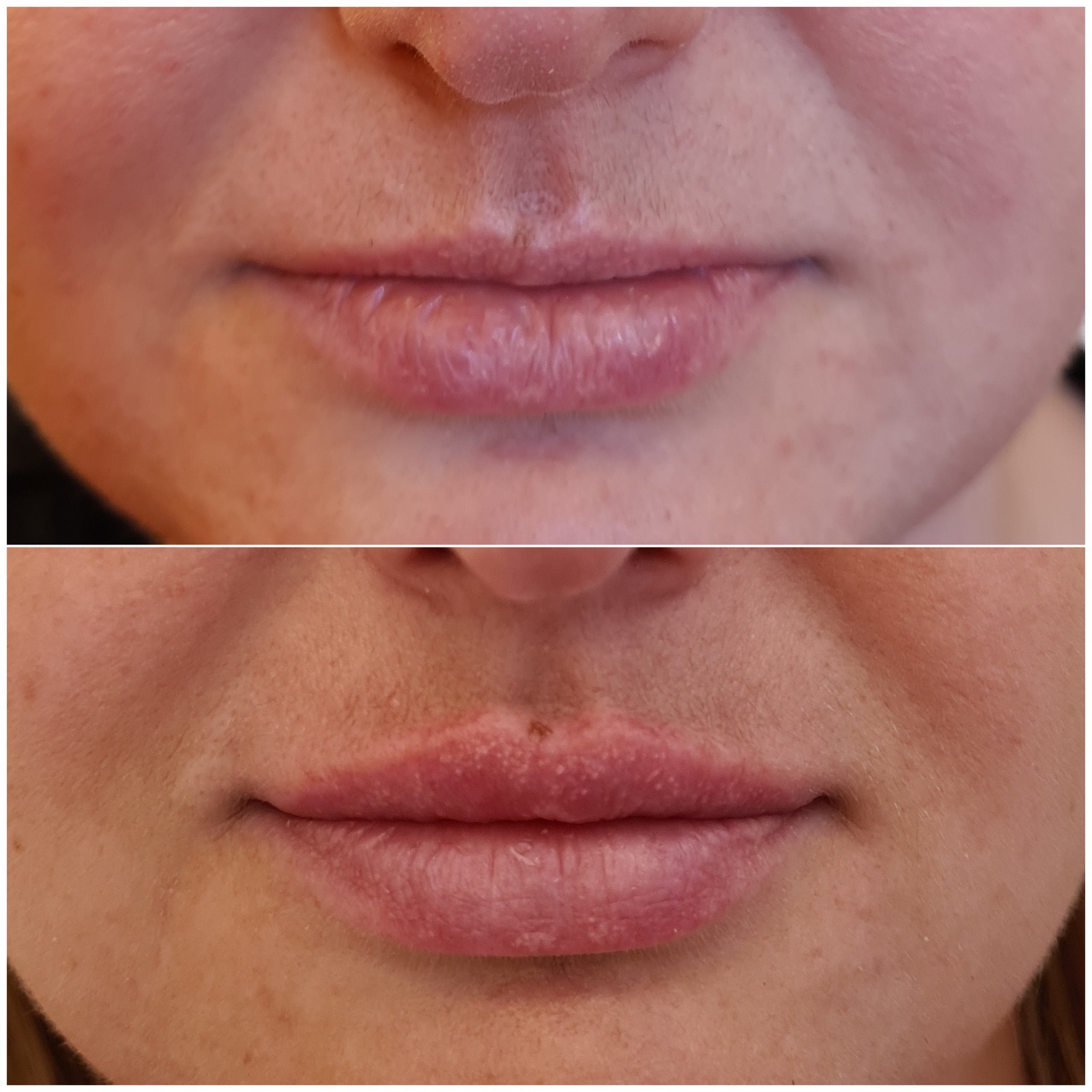 Medycyna estetyczna - przykład zabiegu 12