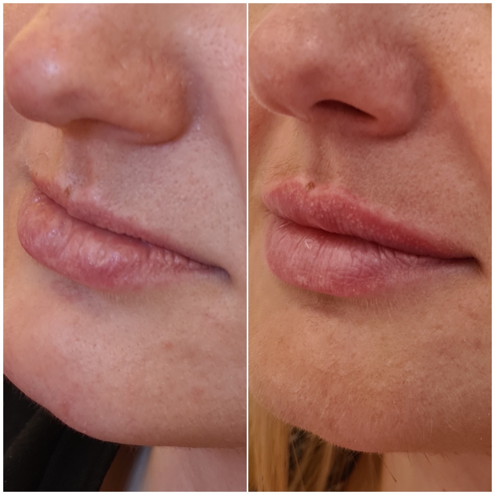 Medycyna estetyczna - przykład zabiegu 13