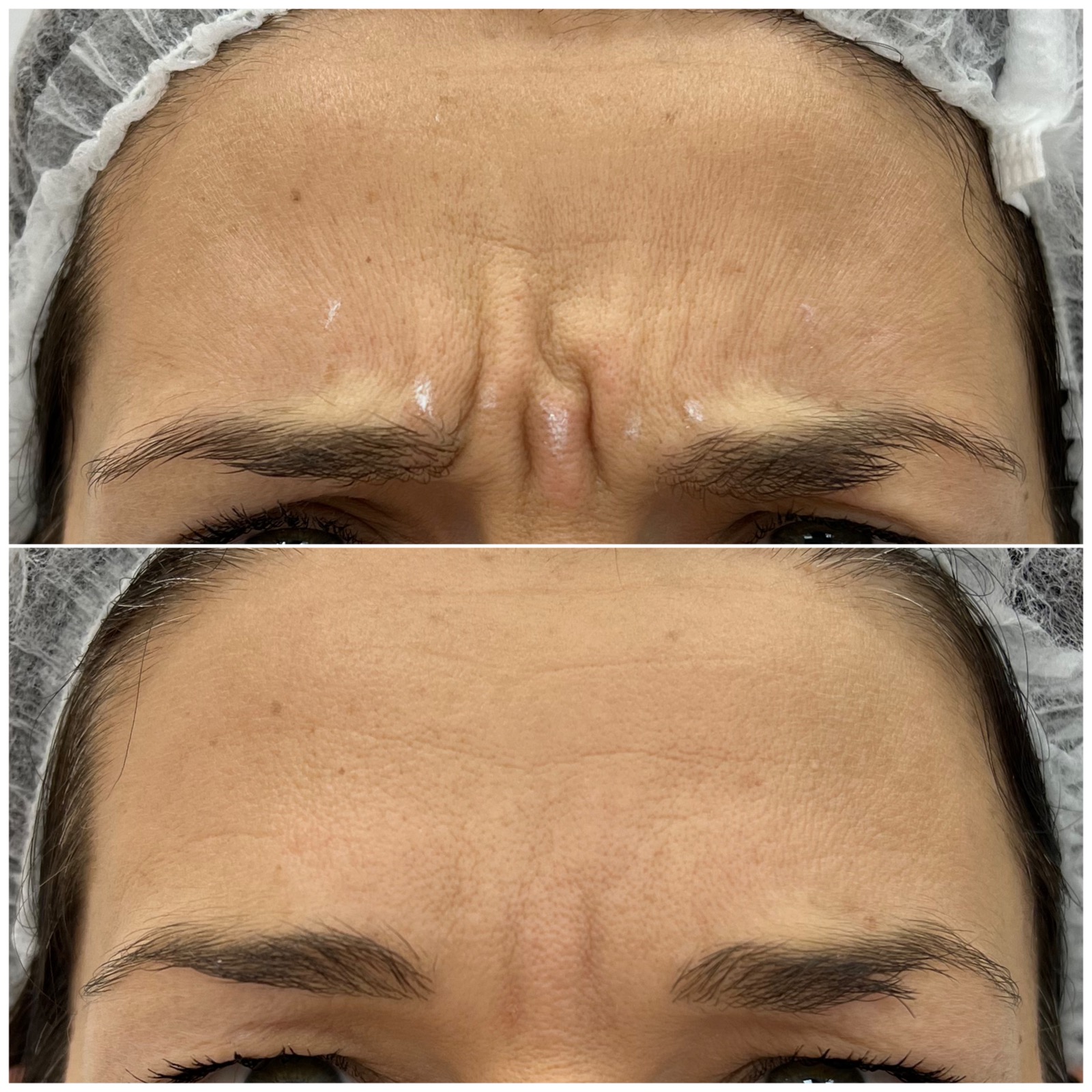 Medycyna estetyczna - przykład zabiegu 14