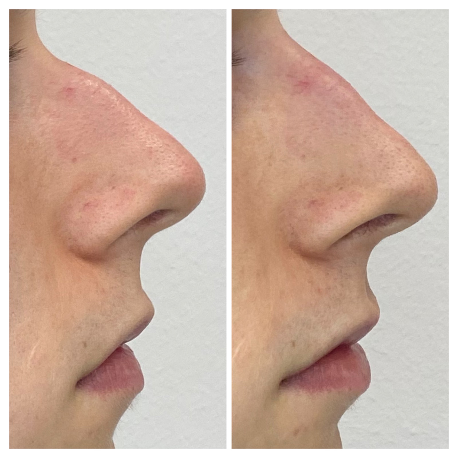 Medycyna estetyczna - przykład zabiegu 15