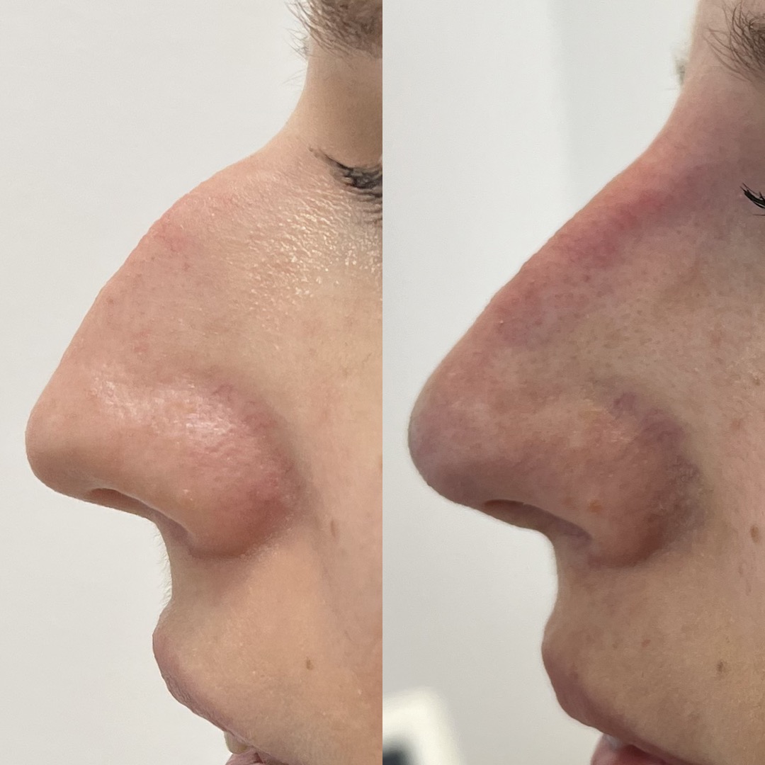 Medycyna estetyczna - przykład zabiegu 16