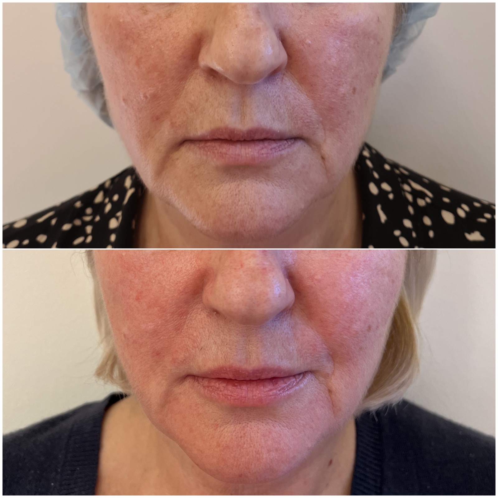 Medycyna estetyczna - przykład zabiegu 2