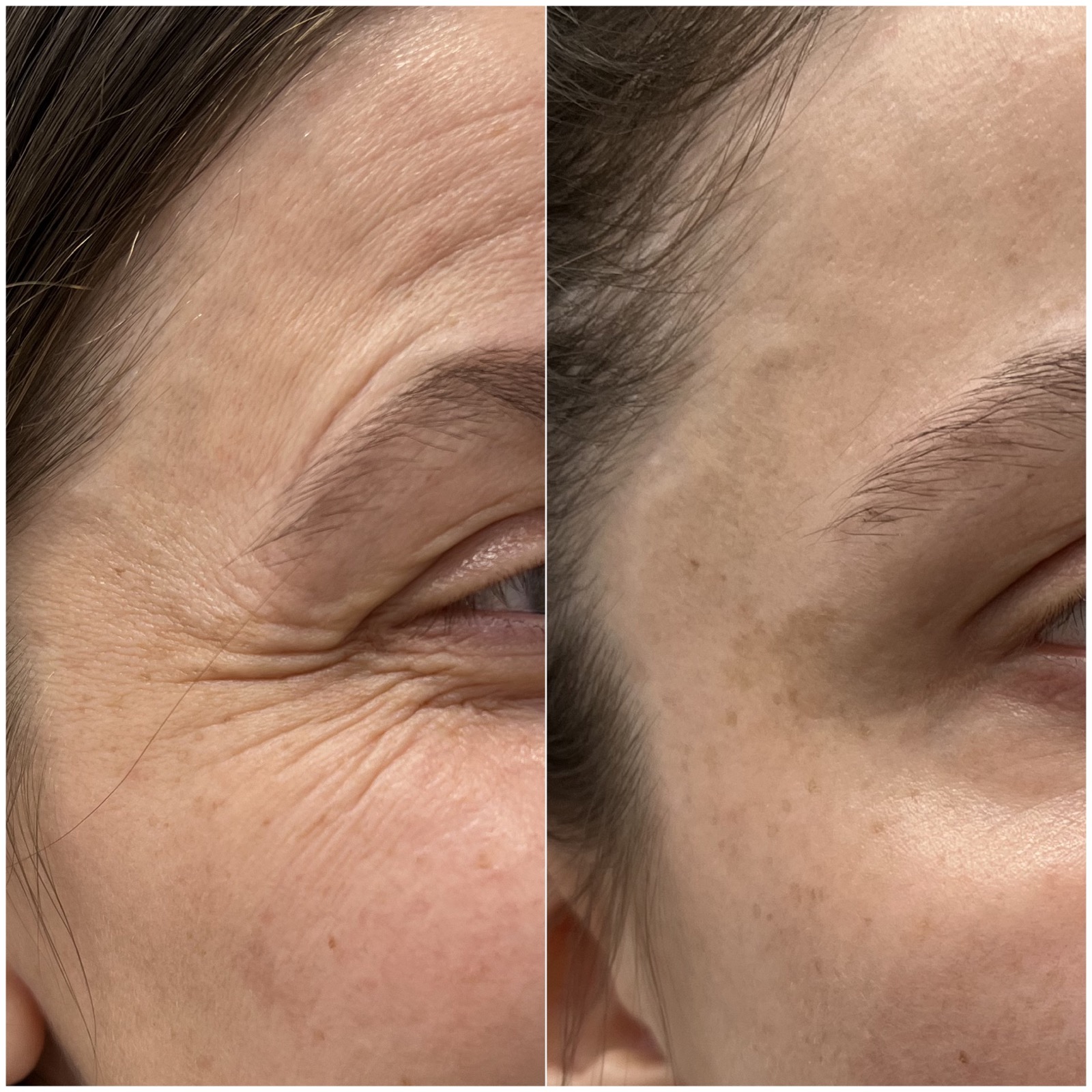 Medycyna estetyczna - przykład zabiegu 3