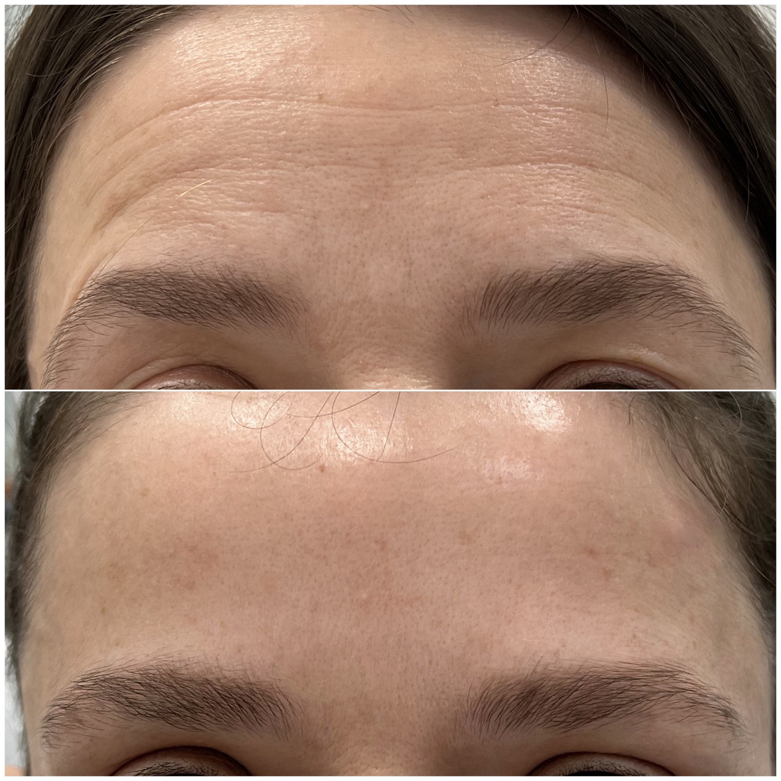 Medycyna estetyczna - przykład zabiegu 4