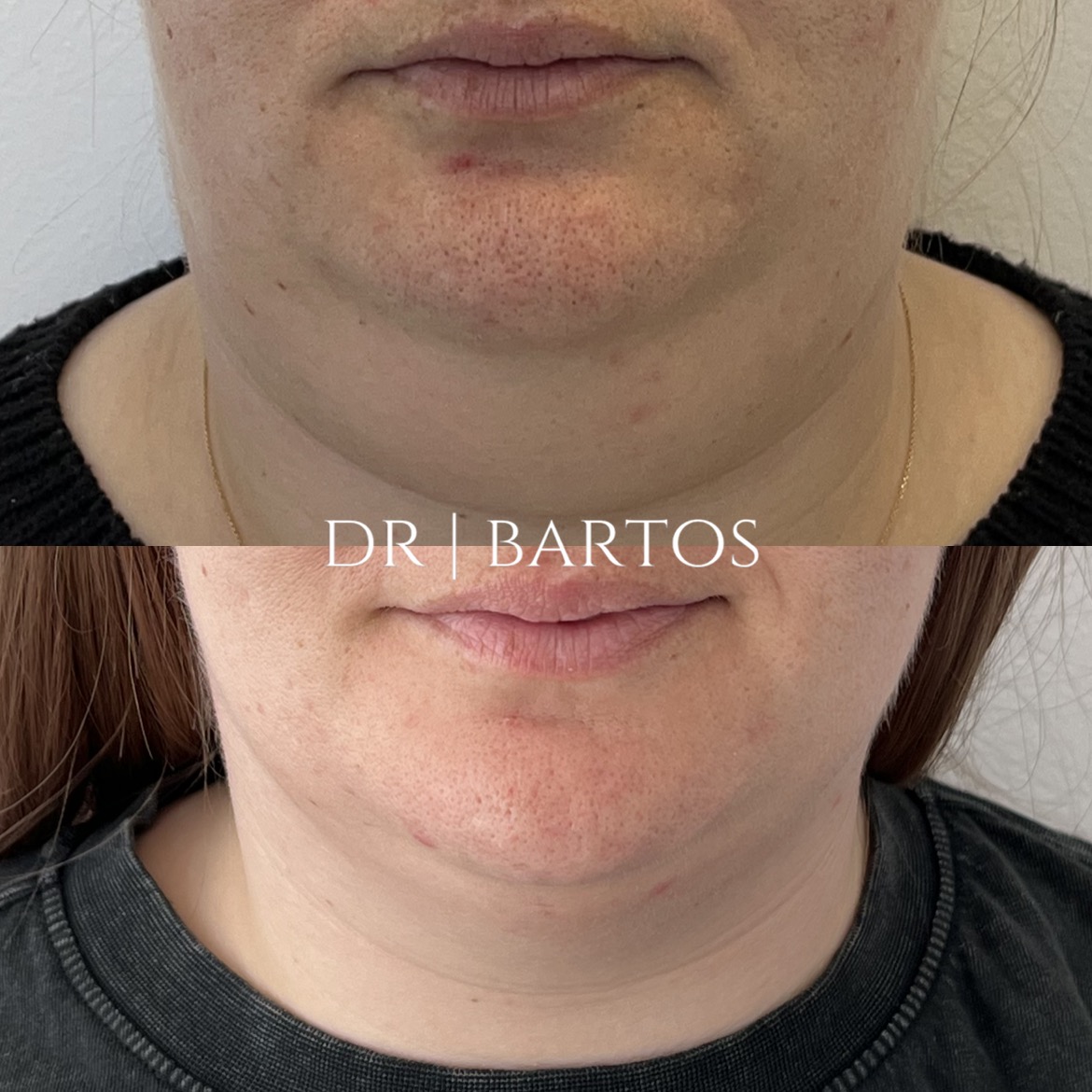 Medycyna estetyczna - przykład zabiegu 5