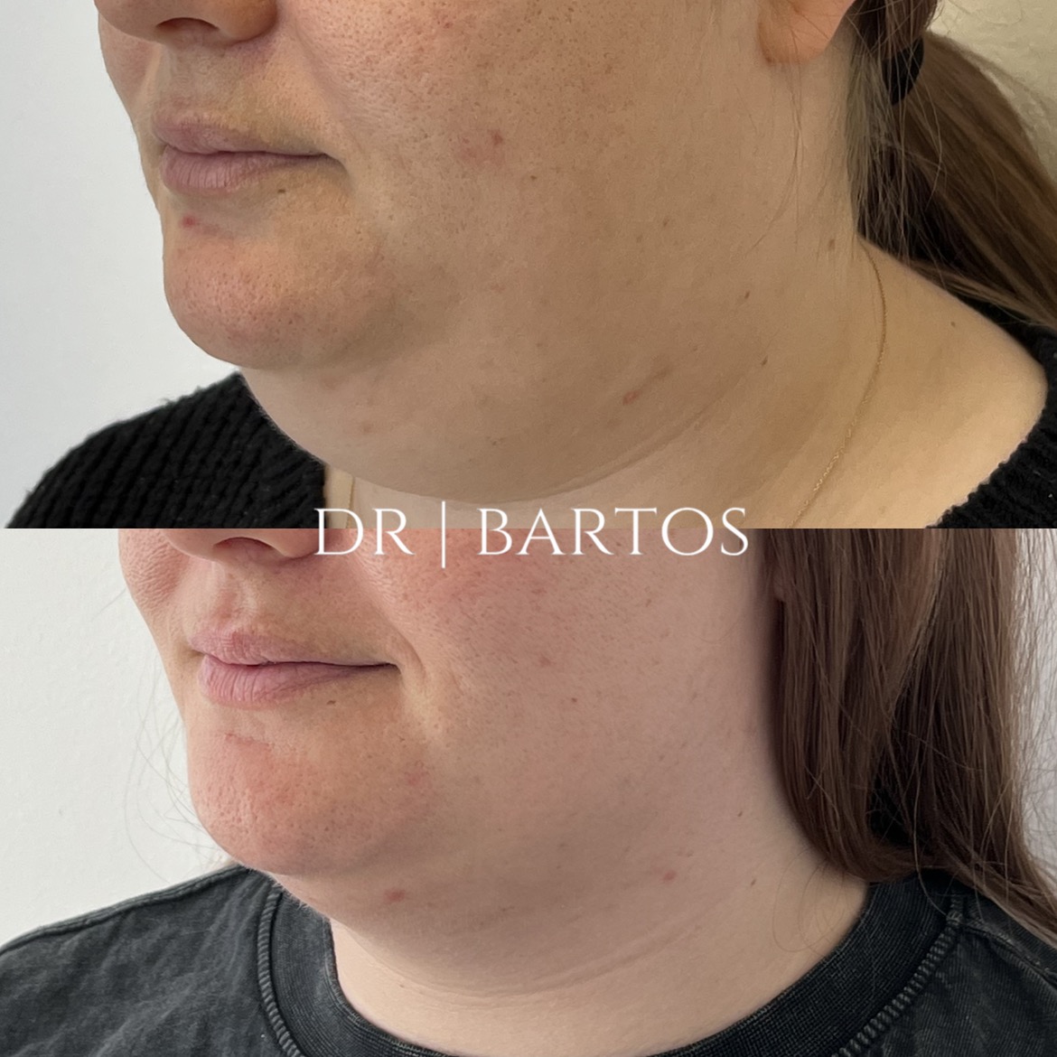 Medycyna estetyczna - przykład zabiegu 6