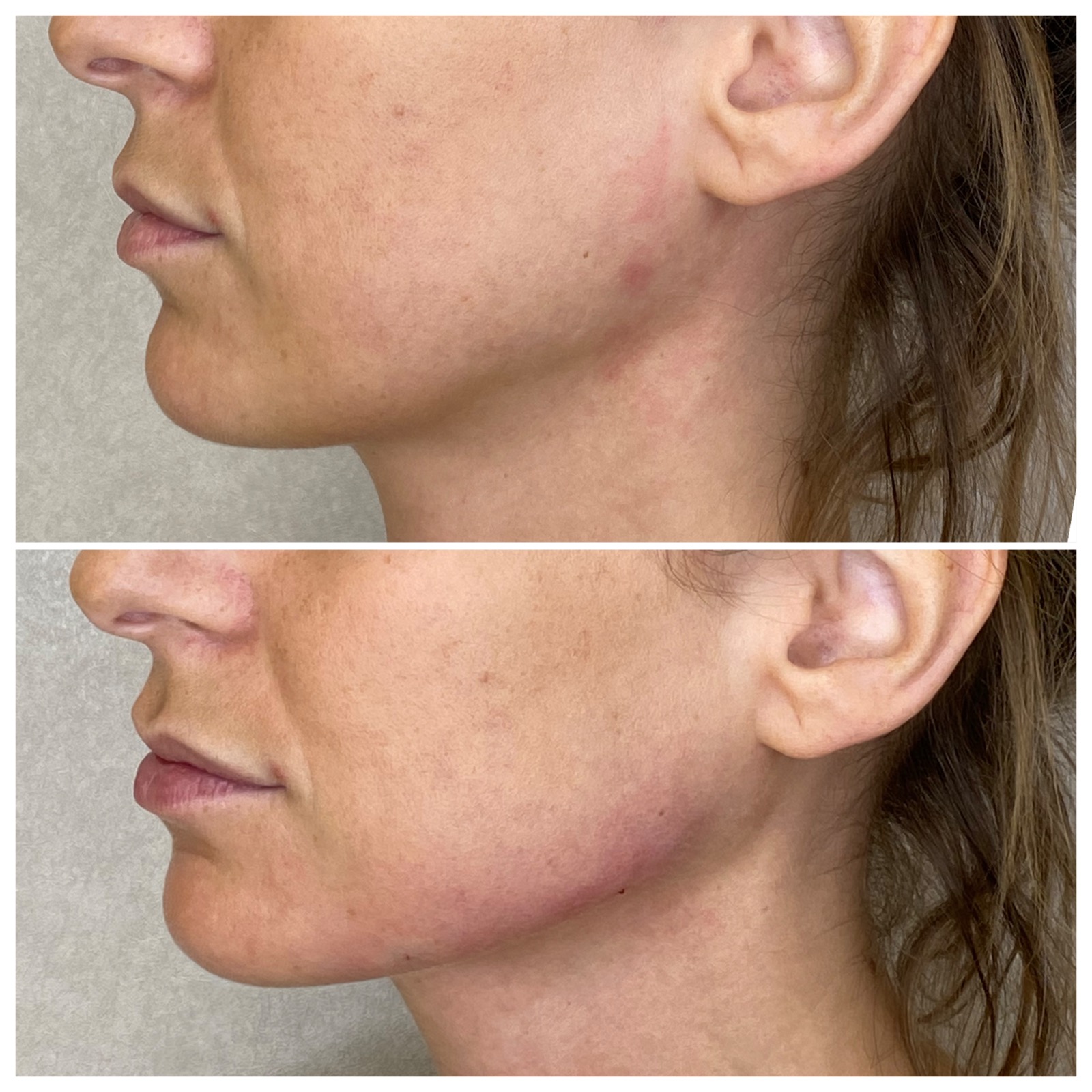 Medycyna estetyczna - przykład zabiegu 7