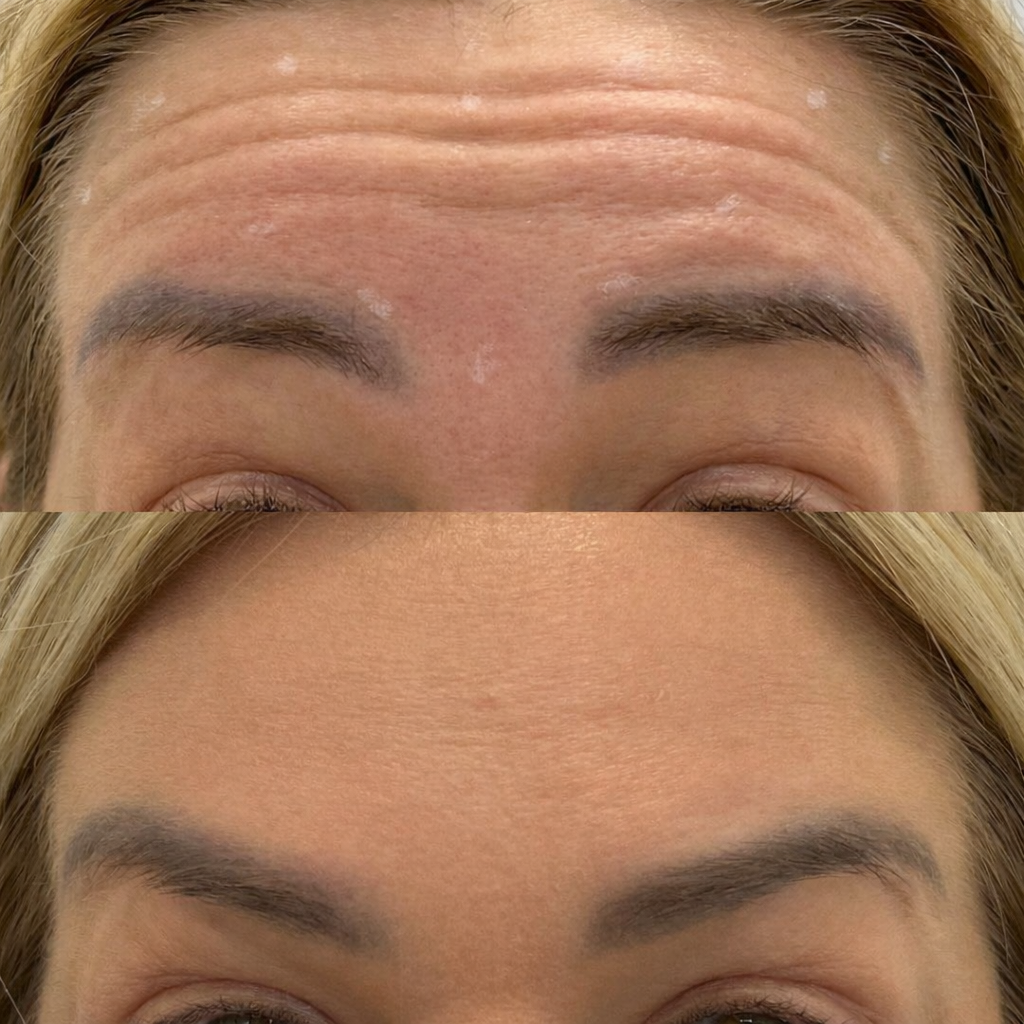 Medycyna estetyczna - przykład zabiegu 9