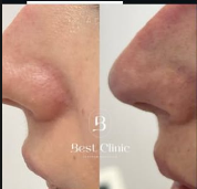 Medycyna estetyczna - przyklad zabiegu 1