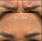 Medycyna estetyczna - przyklad zabiegu 2