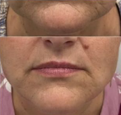 Medycyna estetyczna - przyklad zabiegu 3