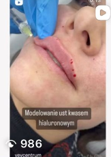 Medycyna estetyczna - przyklad zabiegu 4