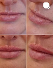 Medycyna estetyczna - przyklad zabiegu 5