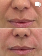 Medycyna estetyczna - przyklad zabiegu 6