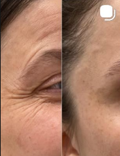 Medycyna estetyczna - przyklad zabiegu 7