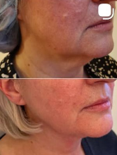 Medycyna estetyczna - przyklad zabiegu 8