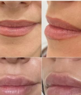 Medycyna estetyczna - przyklad zabiegu 10